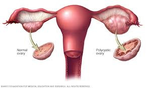 Pcos Pcod Cure With Homeopathy Polycystic Ovary Polycystic Ovarian Dis