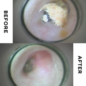 40代 女性 普段綿棒 耳垢タイプ(ドライ)