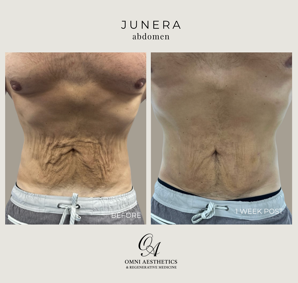 junerabdomen1