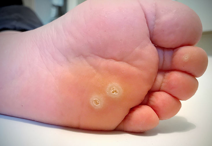 Wart verrucas plantar. Fasciitis Wart on foot. Decease on foot skin. Wart plantar callus f