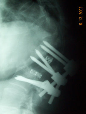 Adjacent segment failure
before repair