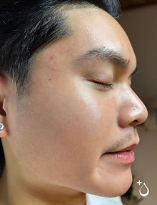 acne treatments in The Villages, Fl