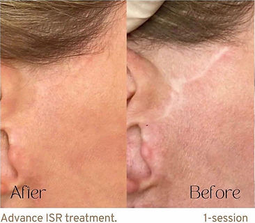 Scar camouflage tattoo results at Radiant Ink Studios, revealing the effectiveness of advanced inkless scar revision (ISR) treatment