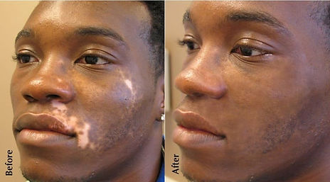 Breast stretch mark camouflage before and after, demonstrating pigment blending for a more uniform skin tone