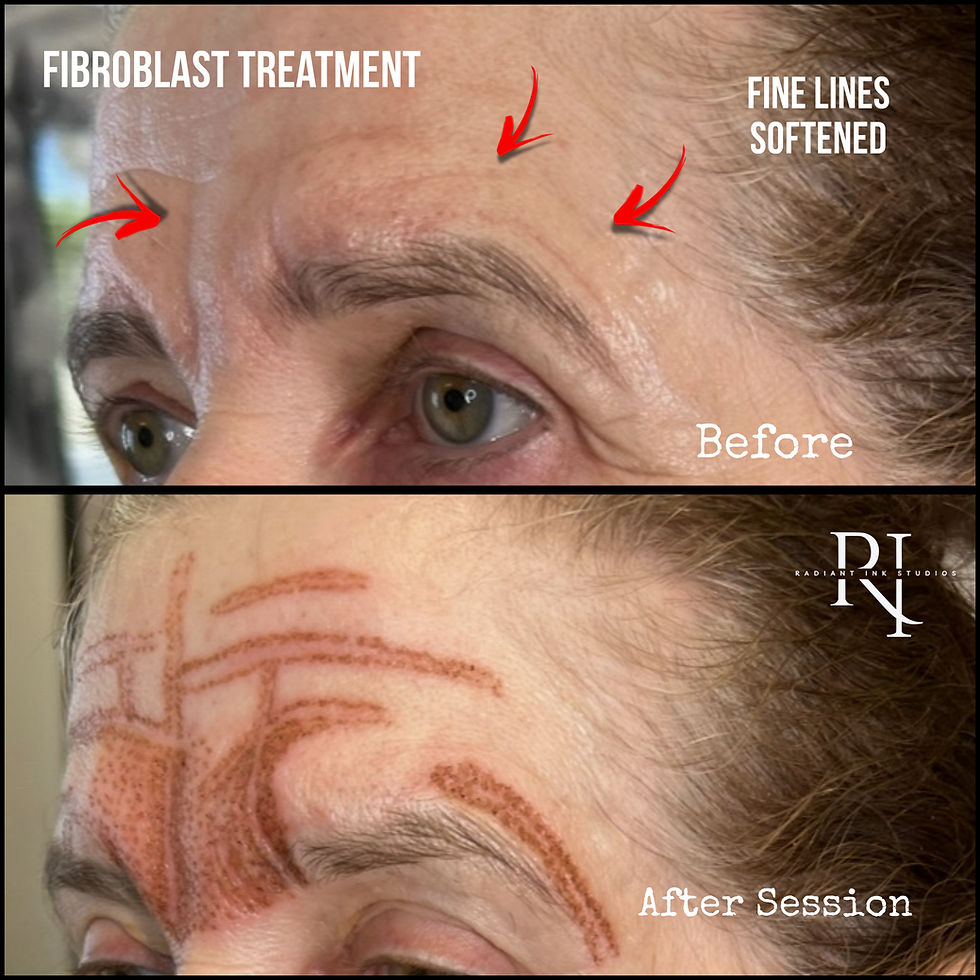 Before and after fibroblast treatment images show reduced fine lines on a forehead. Red arrows indicate changes. Text visible: "Before," "After Session."