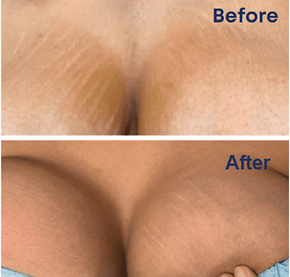 Before-and-after images of stretch mark camouflage on the chest area, showing enhanced skin uniformity after paramedical tattooing at Radiant Ink Studios