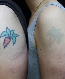 Tattoo Removal_edited.jpg