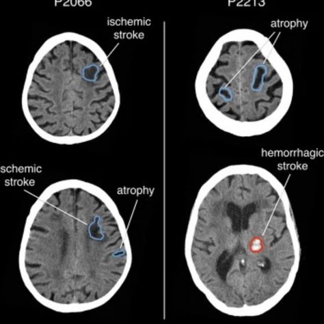 Ischemic vs Hemorrhagic Stroke