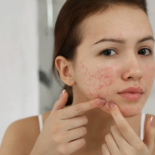 Let's Talk About Acne