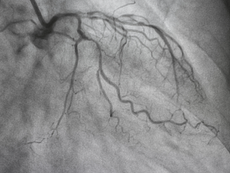 Acute Coronary Syndrome