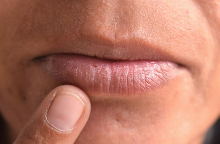 Enfermedad de Sjögren: Inflamación de Glándulas Salivales y Ojos Secos