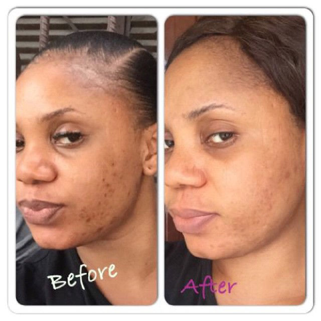 Dark Spot/Sun Burn Removal Cream