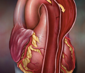 Aortic Dissection