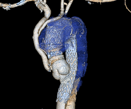 CT scan, aortic aneurysm, aortic dissection, aortic arch, endovascular, stent, aortic endograft, aortic aneurysm, aortic dissection