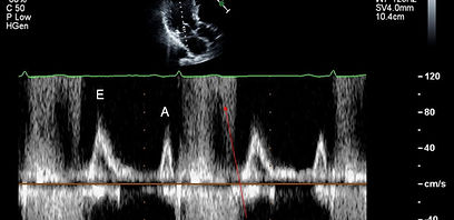 MV inflow PW example aliasing.jpg