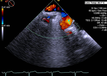 Right Pulm Veins 2.jpg