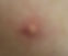 Wart