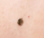 Seborrhoeic Keratosis