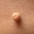Skin Tag