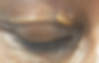 Xanthelasma