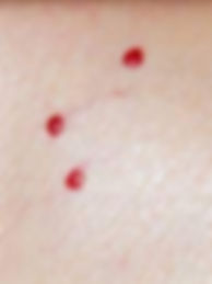Blood Spot