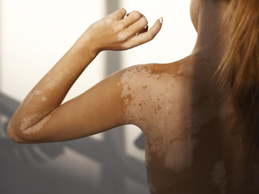 215636 - Vitiligo - Blood Sampling Study - Expenses £25