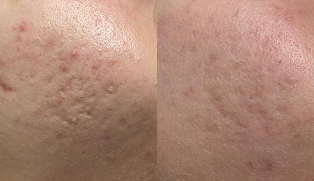 Miicroneedling before - after 1.jpg