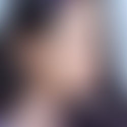 Rhinosplasty-ศัลยกรรมจมูก