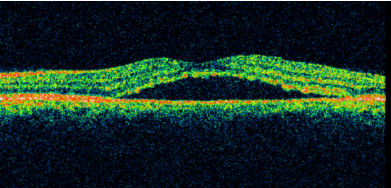 Central Serious Retinopathy