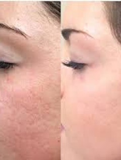 microneedling.jpg