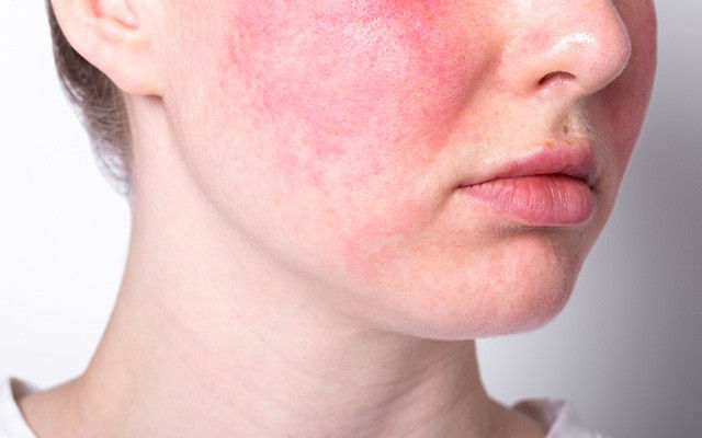 Hydra Treatment: Wann braucht deine Haut einen Feuchtigkeitsboost?