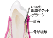 軽度歯周炎
