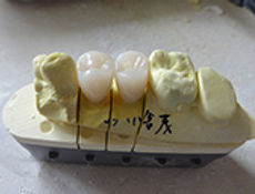 CAD/CAM冠