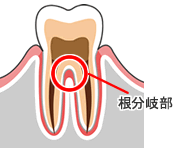 根分岐部
