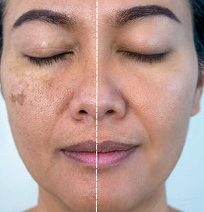 melasma .jpeg