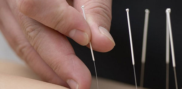 Acupuncture, Southend on Sea
