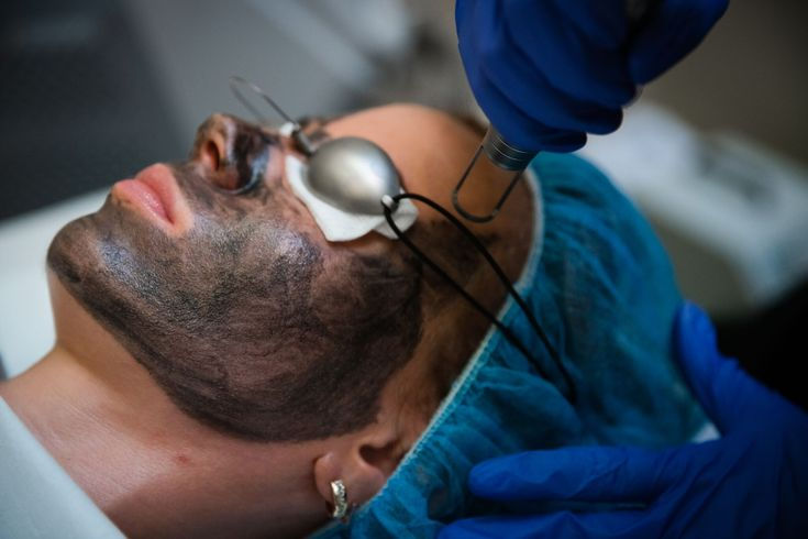 Carbon facial