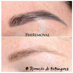 remocaotatuagens