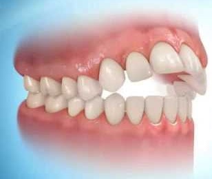 Anterior Open Bite