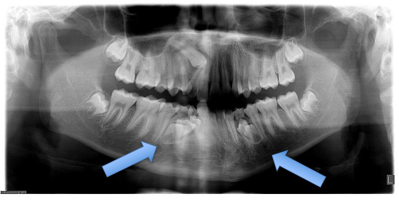 Supernumerary Teeth