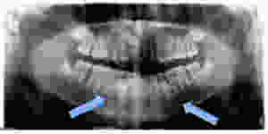Supernumerary Teeth