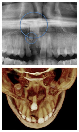 Impacted central incisor