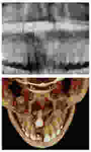 Impacted central incisor