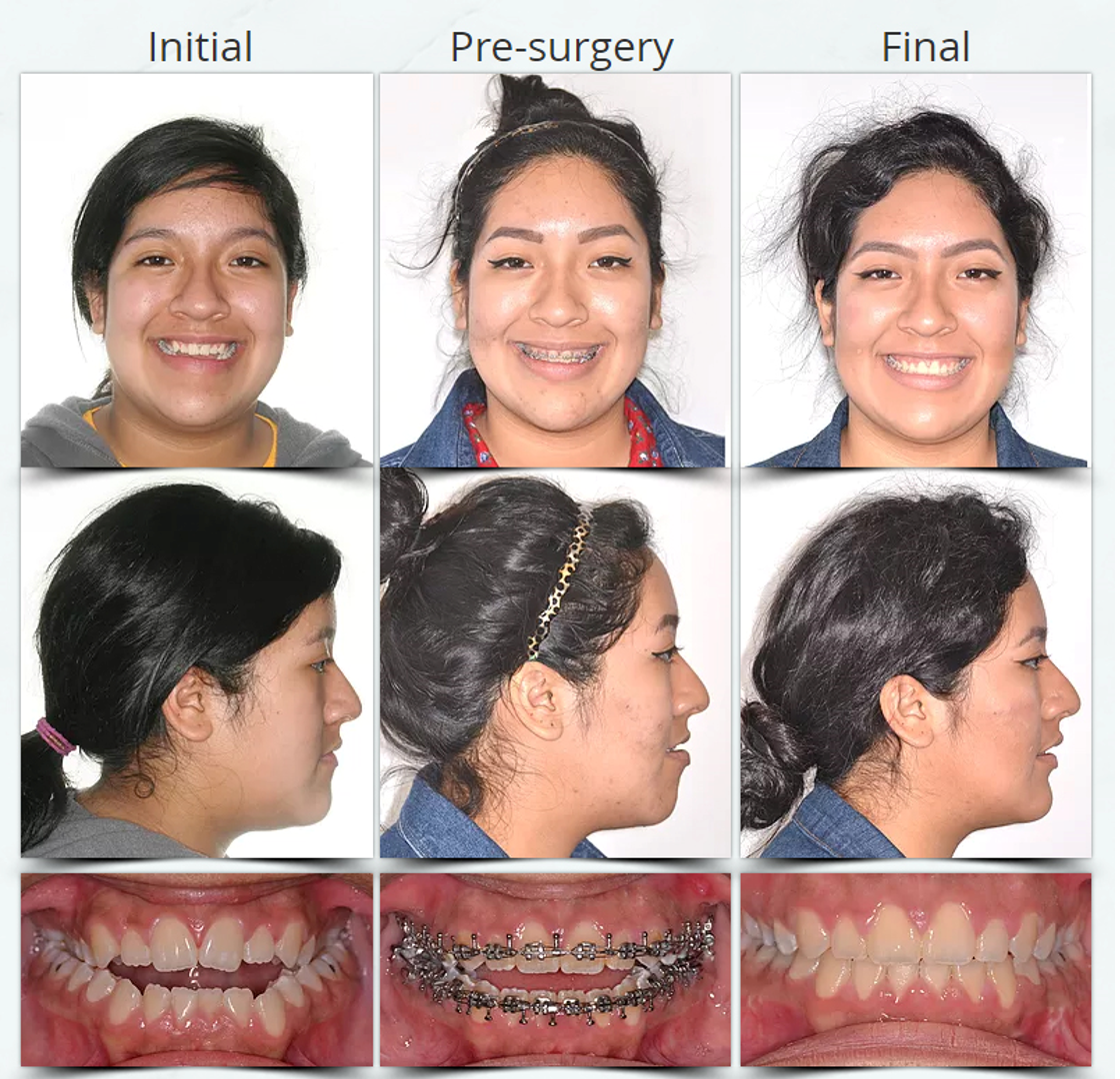 Surgical Orthodontics