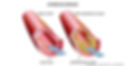 cardiovascular disease