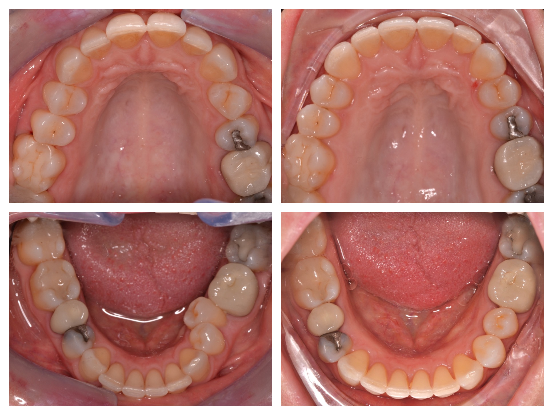Invisalign Treatment