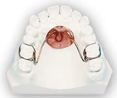 Nance/Transpalatal Arch