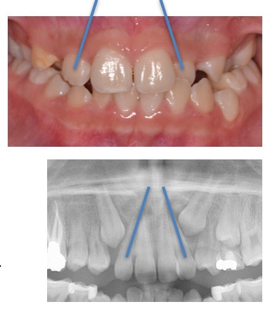 Flared lateral incisors