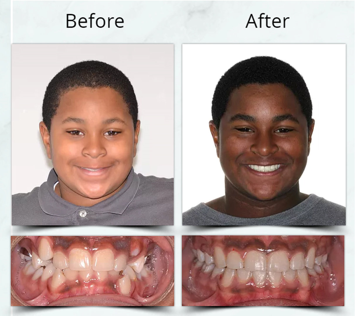 Orthodontic Extraction Treatment