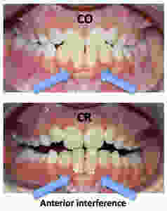 Traumatic Bite